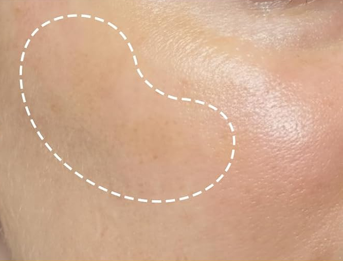 After: close-up of the same skin area.