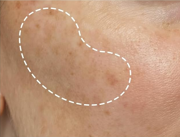 Before: close-up of skin with visible dark spots.